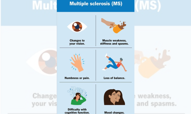 Multiple sclerosis may emerge a decade before neurological symptoms begin to appear Multiple sclerosis may emerge a decade before neurological symptoms begin to appear