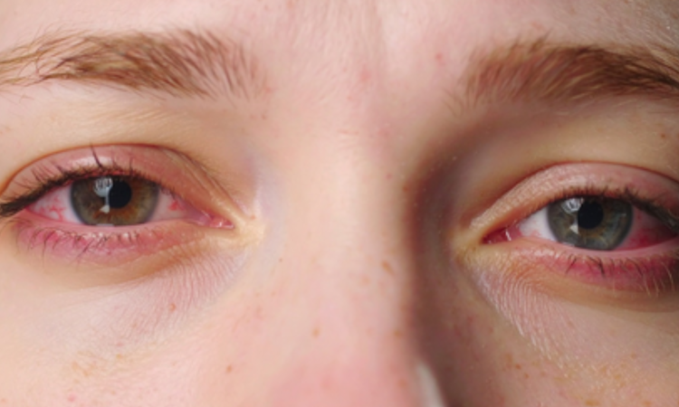 Just 1 hour of social media reels on smartphones can cause eye fatigue: Study
